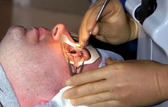 Skleroplastika miopije za stabilizaciju vida