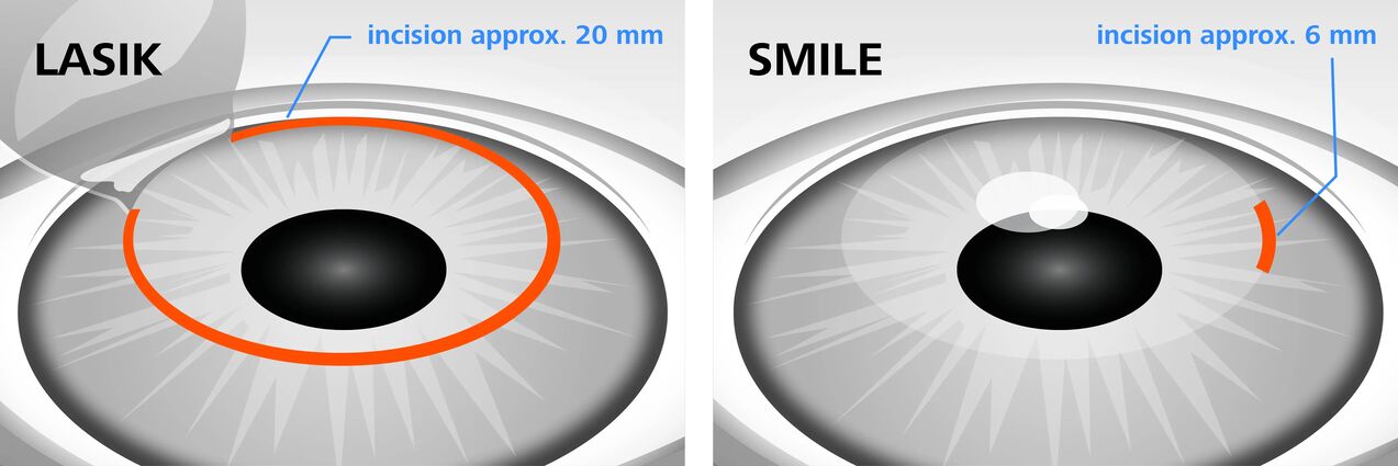 Usporedba metoda laserske korekcije vida LASIK i SMILE